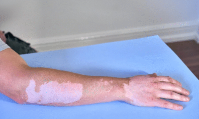 Vitiligo