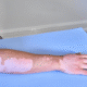 Vitiligo