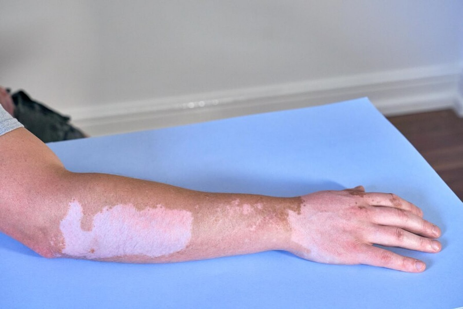 Vitiligo