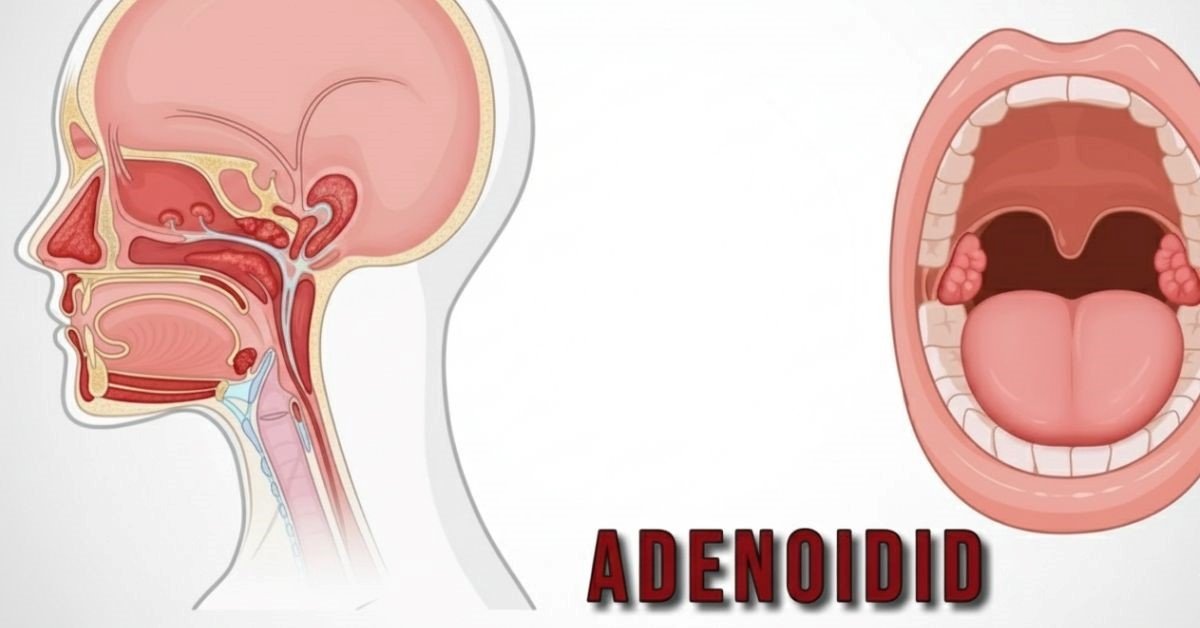 Adenoidid